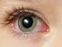 Occhio con congiuntivite, il cui significato è infiammazione. La sclera è arrossata e irritata.