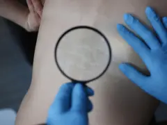 Dłoń w niebieskiej rękawiczce bada lupą rozstępy na plecach.