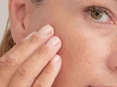 Dita sfiorano il viso, mostrando la texture della pelle e le lentiggini. Forse è il momento di applicare la pomata retinoica per un trattamento mirato.