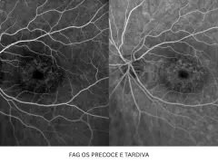 Immagini retiniche con fluoresceina. Possibili effetti collaterali da considerare, ma qui si osservano i vasi sanguigni.