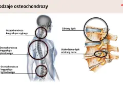 Anatomia kręgosłupa: osteochondroza szyjna może powodować zawroty głowy. Pokazano zdrowy i uszkodzony dysk uciskający nerw.