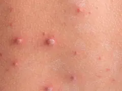 Zmiany skórne po ospie. Jak przyspieszyć gojenie ospy? Widoczne pęcherzyki i zaczerwienienia na skórze.