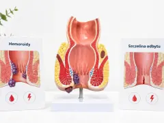 Model anatomiczny odbytu z zaznaczonymi hemoroidami. Choć obrazek dotyczy dorosłych, problem hemoroidów u dzieci również istnieje.