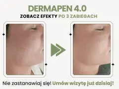 Dermapen 4.0 na co? Zobacz efekty po 3 zabiegach: skóra wygładzona, bez niedoskonałości. Umów wizytę!
