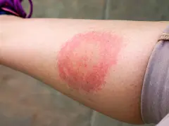 Borrelien Symptome beim Menschen: Warnzeichen, die Sie nicht ignorieren sollten