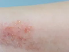Alergia u dziecka: Jaki lek wybrać? Kiedy do lekarza?