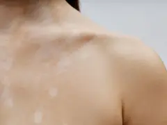 Piel con manchas claras, como si fueran **hongos en la espalda**, cubriendo el cuello y hombro.