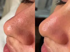 Before and after a hydro infusion facial, showing a nose with visible pores and blackheads transformed into smoother, clearer skin.