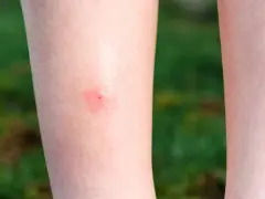 Czerwona, swędząca plamka na skórze nogi po ugryzieniu meszki.