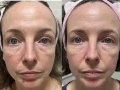 Confronto viso: pelle con niacinamide prima e dopo. Miglioramento di rossori e texture.