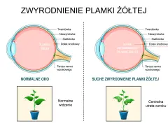 Porównanie zdrowego oka z suchym zwyrodnieniem plamki żółtej. Pokazuje, jak szybko powiększa się otwór plamki żółtej, prowadząc do utraty wzroku.