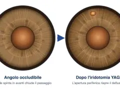 Iridotomia YAG: prima occlusione dell'angolo, dopo apertura per riaprire il deflusso. Valutare i rischi.