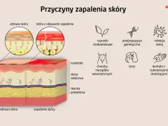 Ilustracja porównująca zdrową skórę i skórę z zapaleniem, z ikonami przedstawiającymi przyczyny AZS.