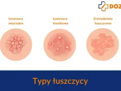 Ilustracje pokazują różne typy łuszczycy: zwyczajną, krostkową i erytrodermię łuszczycową. Ważne, by znać objawy łuszczycy u dzieci.