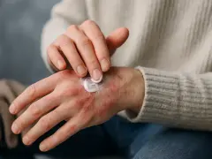 Dłoń z zaczerwienioną, zapalną skórą, na którą nakładany jest biały krem.