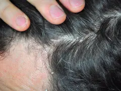 Dedos separando cabello oscuro con caspa blanca. ¿Cómo aliviar el picor de cabeza por estrés?