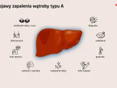 Objawy zapalenia wątroby typu A: zażółcenie skóry, bóle brzucha, brak apetytu, nudności, biegunka, osłabienie, gorączka, bóle stawów, swędzenie skóry.