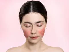 Rötungen im Gesicht, vielleicht eine retinol warnung? Die Haut ist gerötet, die Augen geschlossen.
