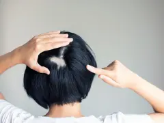 Eine Frau entdeckt kreisrunden Haarausfall am Hinterkopf. Ihre Hände berühren die kahle Stelle, die sich deutlich vom dunklen Haar abhebt.