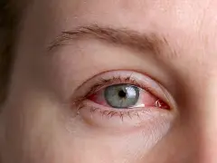 Occhio arrossato e irritato, possibile infezione oculare. Il nome di questa condizione è congiuntivite.