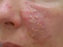 Rötungen im Gesicht: Was hilft wirklich gegen Couperose & Rosazea?