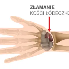 Boli nadgarstek? Skręcenie czy złamanie? Rozpoznaj i pomóż sobie