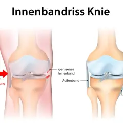 Illustration zeigt einen **Innenbandriss Knie**. Links die Kraftrichtung, rechts das gerissene Innenband im Vergleich zum gesunden.