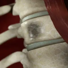 Detailaufnahme der Wirbelsäule mit einem dunklen Fleck auf einem Wirbelkörper, der auf multiples Myelom hindeutet. Woran stirbt man bei dieser Krankheit, ist eine wichtige Frage.