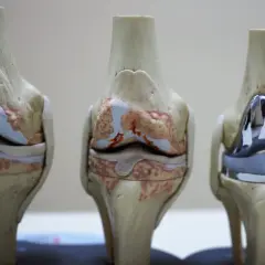 Modele anatomiczne stawów kolanowych: dwa zdrowe, jeden z widoczną endoprotezą kolana.