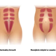 Ilustracja porównuje normalny brzuch z rozejściem mięśni brzucha w czasie ciąży, pokazując rozdzielenie mięśni prostych brzucha.