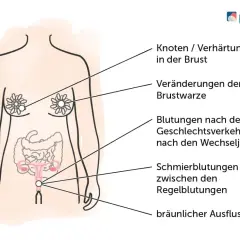 Illustration zeigt Symptome, die auf einen Unterschied zwischen Tumor und Karzinom hinweisen können: Knoten in der Brust, Brustwarzenveränderungen, Blutungen und Ausfluss.
