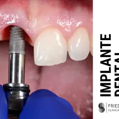 Proceso de colocación de un implante dental. Un tornillo metálico se inserta en la encía, cerca de dientes naturales.