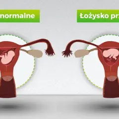Porównanie: łożysko normalne vs łożysko przodujące. Grafika pokazuje macicę z płodem, ilustrując różnice w położeniu łożyska.
