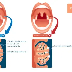 Ilustracja porównująca zdrowe migdałki z migdałkami z kamieniami, pokazująca ich budowę i objawy.