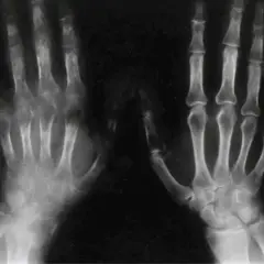 RTG dłoni ukazujący zmiany kostne charakterystyczne dla zespołu sudeckiego. Widoczne są objawy osteoporozy, obrzęki i zwężenia przestrzeni stawowych.