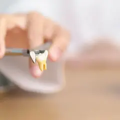 Un dente estratto con pinze, un monito per chi teme di rimanere senza denti a 40 anni.