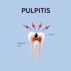 Illustrazione di un dente con carie che causa infiammazione del nervo del dente (polpa).