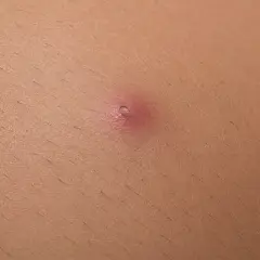 Primo piano di un pelo incarnito, un piccolo brufolo rosso sulla pelle. Ecco come togliere un pelo incarnito.