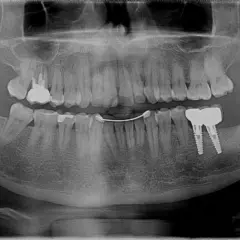 Radiografia panoramica dentale mostra impianti dentali e una protesi. Si nota una sacca gengivale in corrispondenza di un dente.