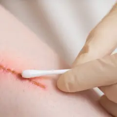 Une cicatrice qui saigne une semaine après opération, nettoyée avec un coton-tige. La peau est rouge autour de la plaie.
