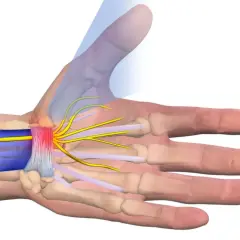 Illustrazione anatomica dei nervi del polso, evidenziando la compressione e l'infiammazione dei nervi che si diramano verso le dita.