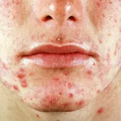 Nahaufnahme eines Gesichts mit starker Akne, Rötungen und Pickeln. Diese mallorca-akne bilder zeigen die Hautirritation.