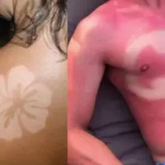 Un coup de soleil révèle un tatouage en forme de fleur d'hibiscus sur une épaule. Sur la droite, un autre coup de soleil dessine le symbole de Batman sur un torse.