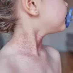 Skóra dziecka z widocznym zaczerwienieniem i zmianami skórnymi na szyi, sugerującymi **egzemę u dzieci**.