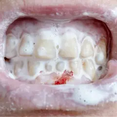 Krwawiące dziąsła i piana na zębach. To może być objaw problemów, którymi zajmuje się periodontologia. Co to jest?