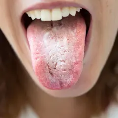 Lingua con placche biancastre, segno di candida in bocca.