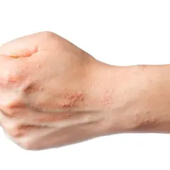 Dłoń z licznymi, czerwonymi pęcherzykami i grudkami, objawy świerzbiączki letniej.