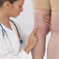 Lekarz bada nogi pacjentki, oceniając potencjalny stan zapalny i jego związek z d-dimerami.