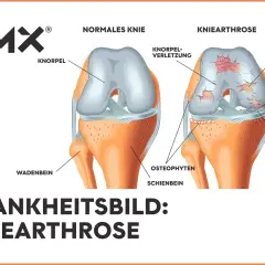 Vergleich von gesundem Knie und Kniearthrose. Die Darstellung zeigt Knorpelverschleiß, Erosionen und Knochenreizungen – eine mögliche "wunderwaffe gegen arthrose knie" könnte hier Abhilfe schaffen.