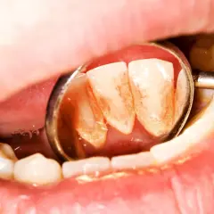 Widok zęba z kamieniem nazębnym w lustrze dentystycznym. Czy kamień nazębny śmierdzi? Tak, może powodować nieprzyjemny zapach.